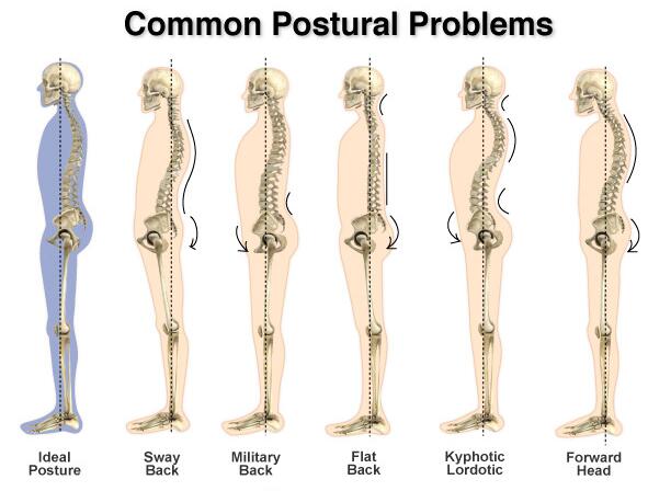 Common Posture Problems