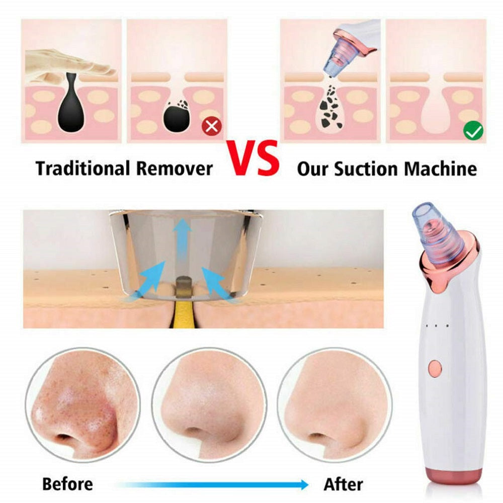 Blackhead Remover Cleaner Tool Electric Pore Acne Pimple Removal